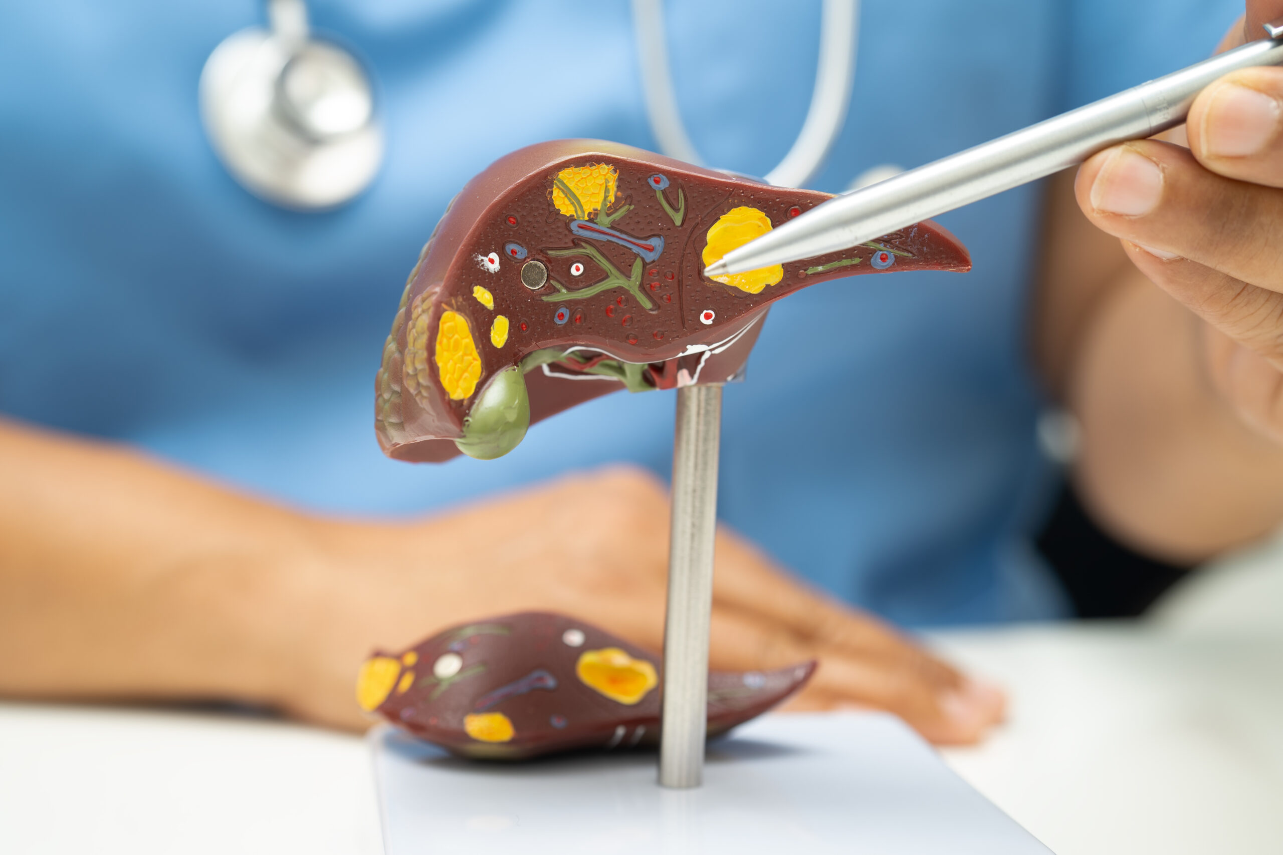 An image of a doctor pointing at a diagram of a liver that shows fatty deposits.